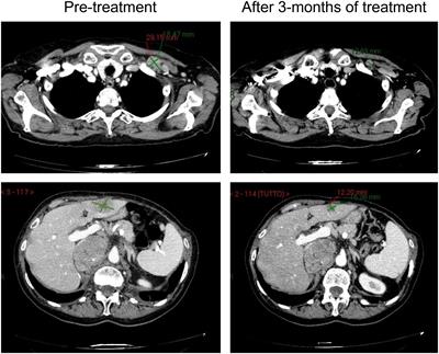 Cisplatin-based chemotherapy for the treatment of metastatic collecting duct carcinomas: A real-world, retrospective analysis